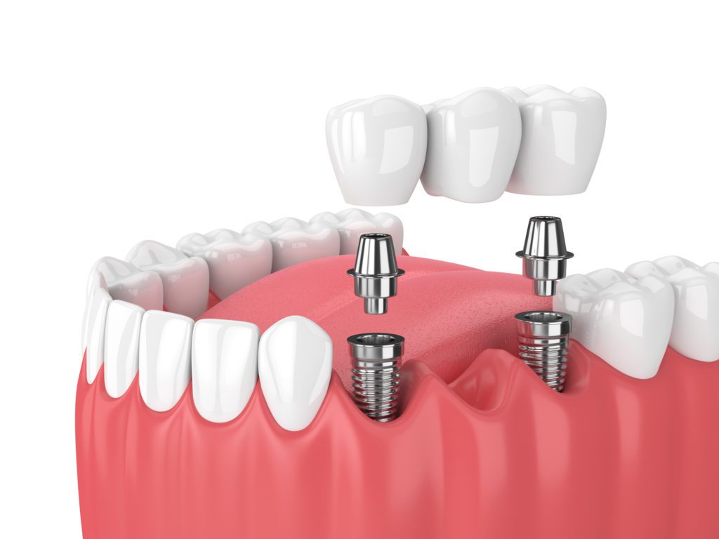 Dental Bridges in Ellicott City, Maryland