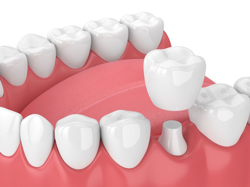 dental crown benefits in Ellicott City Maryland