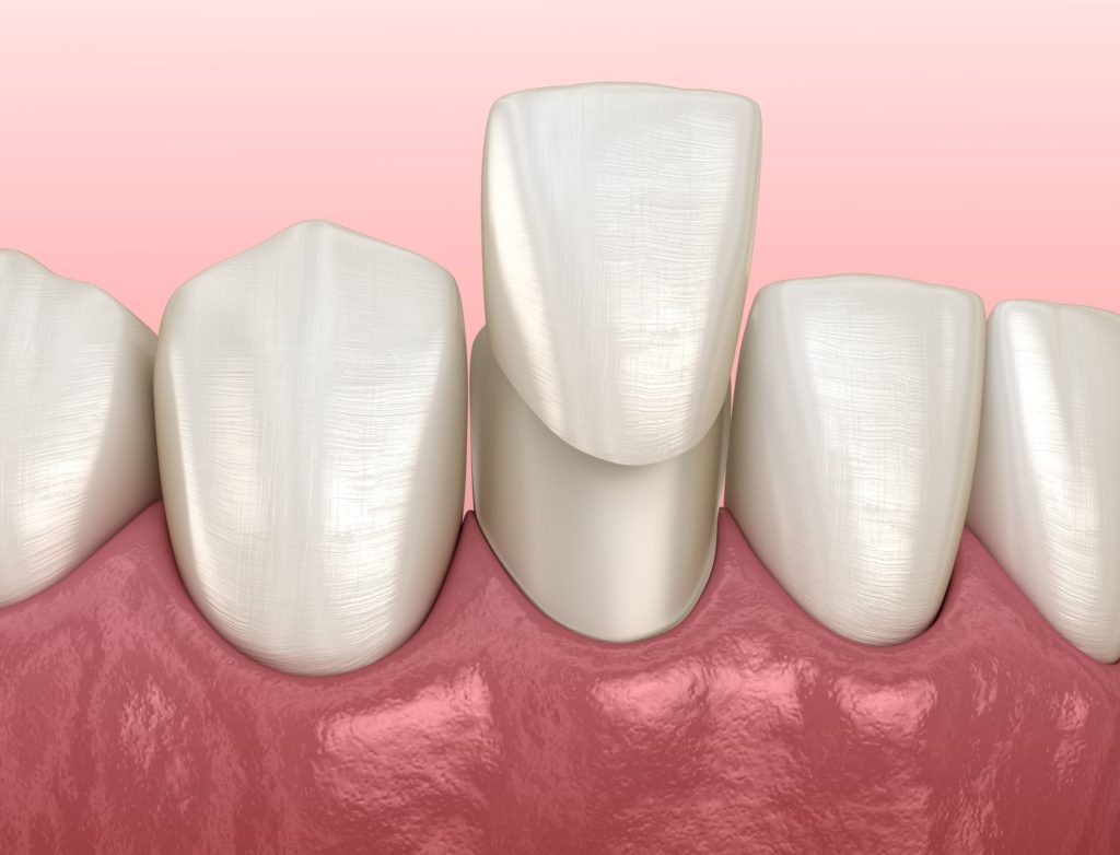 dental health improvement with porcelain veneers