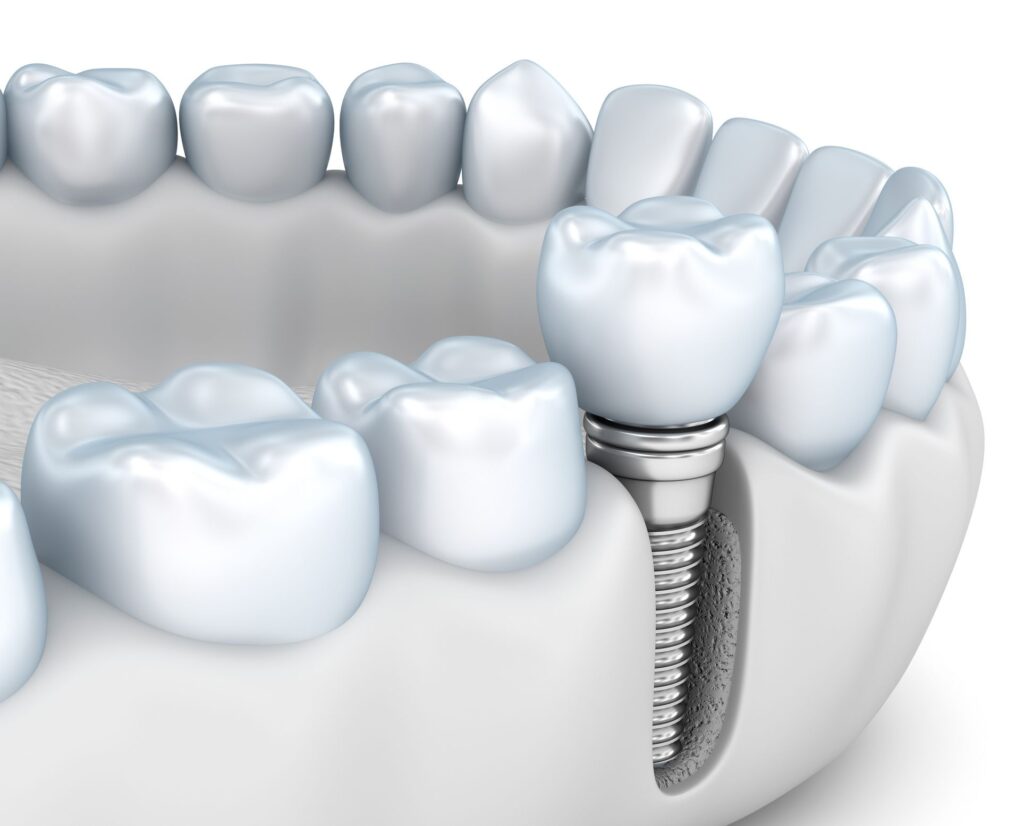 Missing Teeth Hurt Jawbone Health