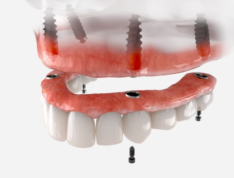 Dental implants have revolutionized the way we approach tooth replacement. They offer a durable and aesthetically pleasing solution.