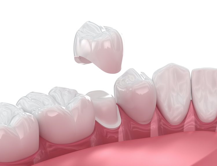 Although dental crowns are designed to be strong and durable, they can still fall off due to factors like tooth decay, wear, or trauma.
